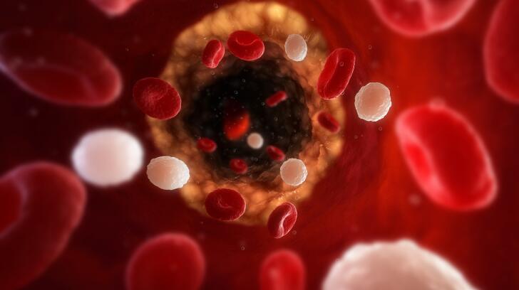 10 Complications Of High Blood Pressure