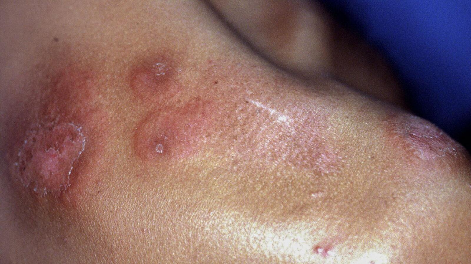 Ulcerative Colitis Rashes: Skin Conditions, Symptoms, Treatment