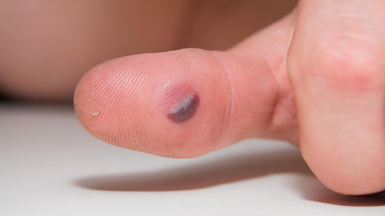 Bullae Pictures, Causes, Symptoms, Treatments, and More