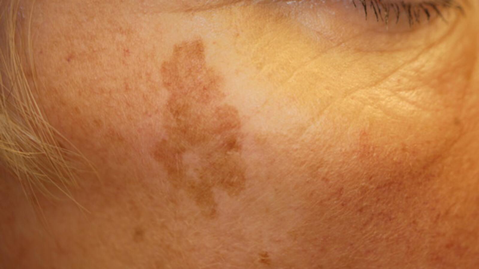 Liver Spots Causes Symptoms Treatments And More 