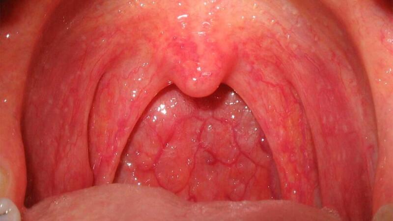 This image shows a person's throat appearing red with swelling and bumps, similar to cobblestones.