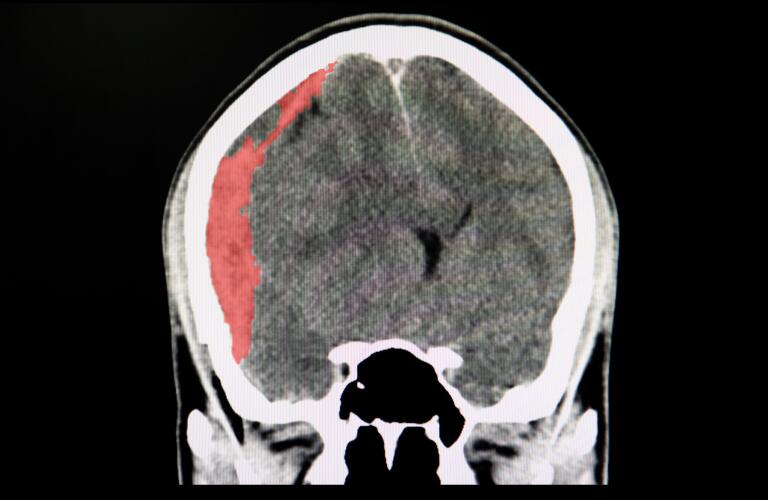 A CT scan of a trauma patient with subdural hematoma
