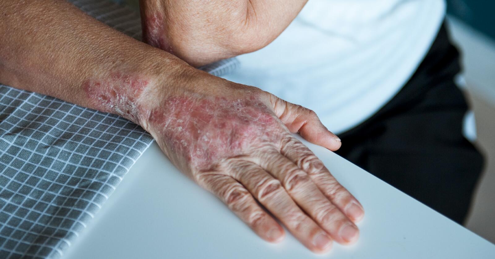 Rash on Hands: Symptoms, Treatments, Causes, and More