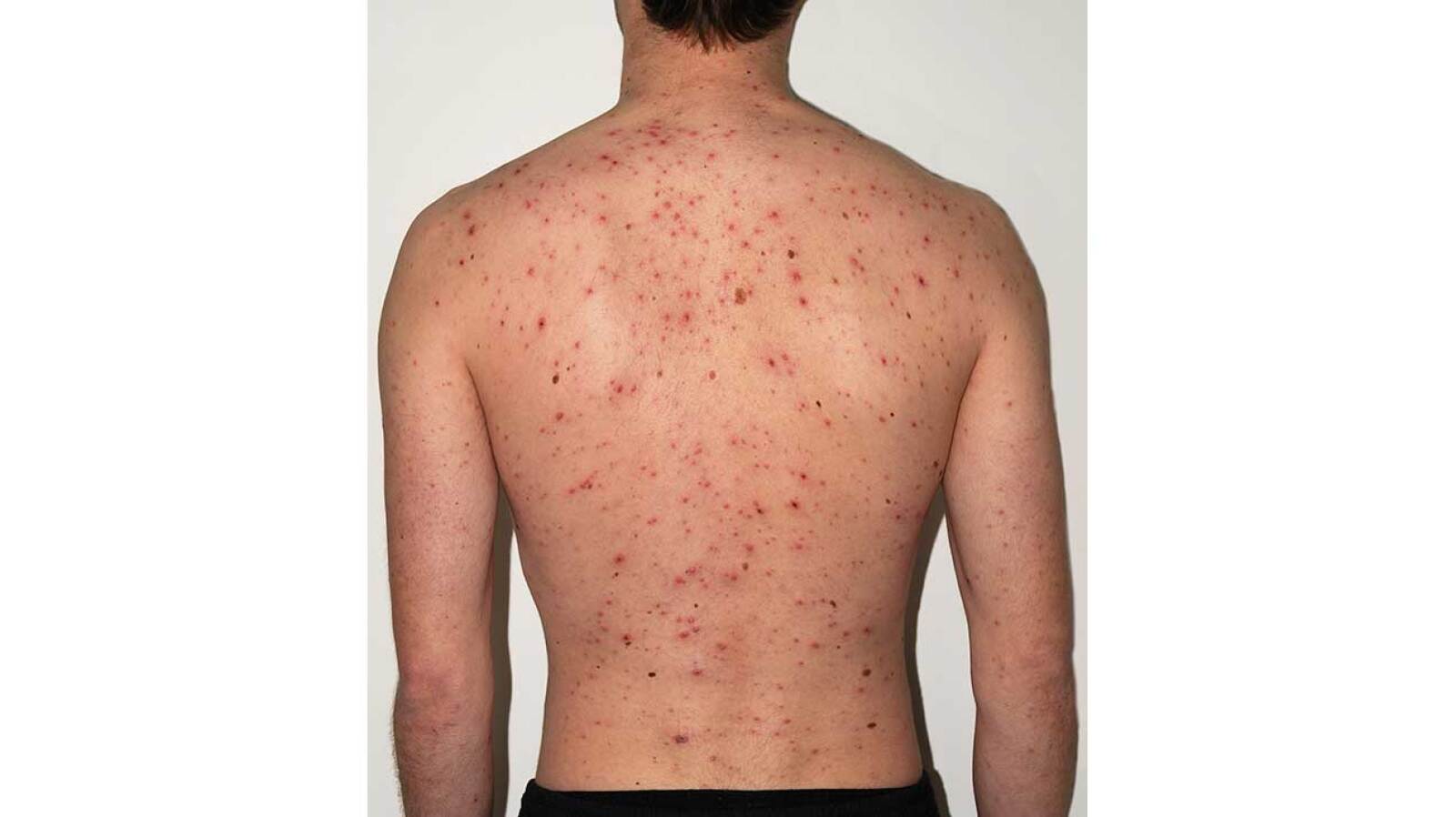 Rash on Back Causes Treatments, Symptoms, and More