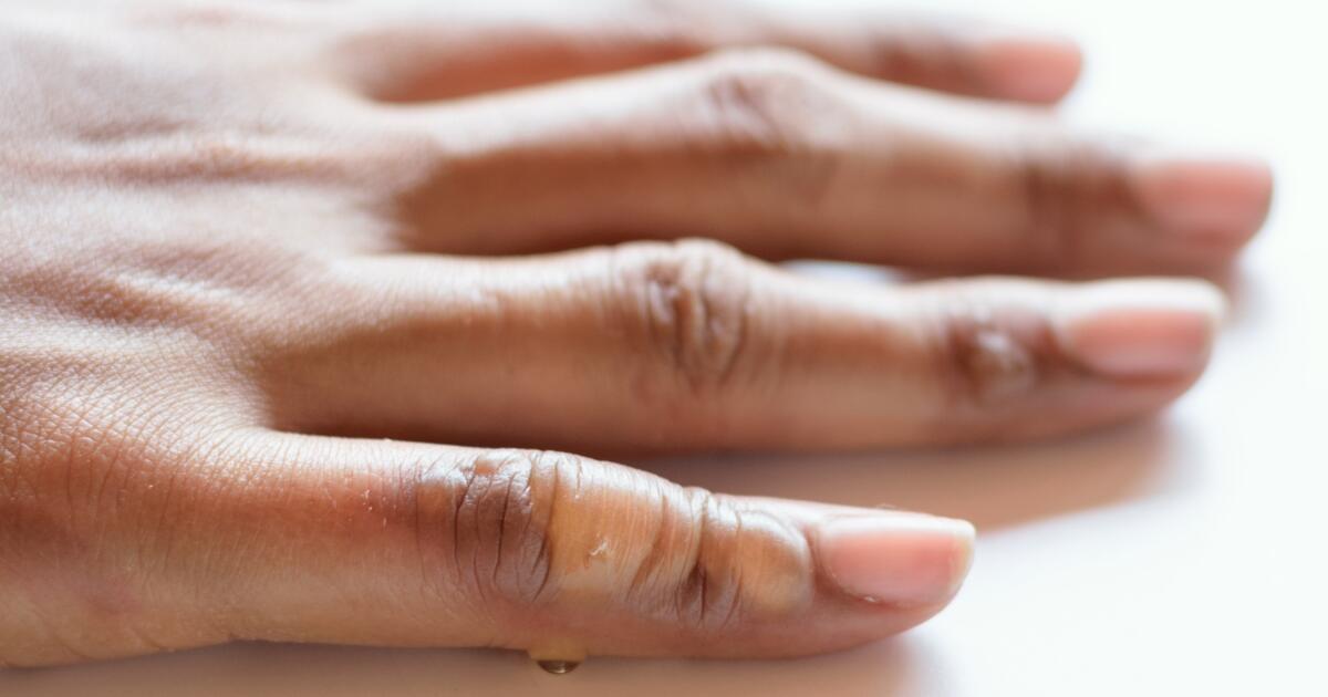 Types Of Burns By Degree | First, 2Nd & 3Rd Degree Burns