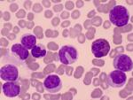 Chronic Myelogenous Leukemia (also called Myleoid Leukemia) many myeloblasts (immature white blood cells or leukocytes)  