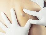 doctor diagnosis of a sebaceous cyst on a woman's back 