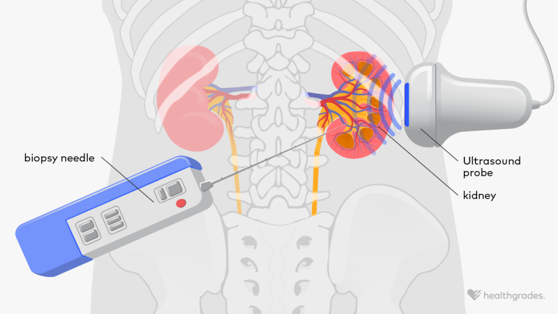 Kidney Sample Kidney Biopsy: Purpose, Procedure, and What to Expect
