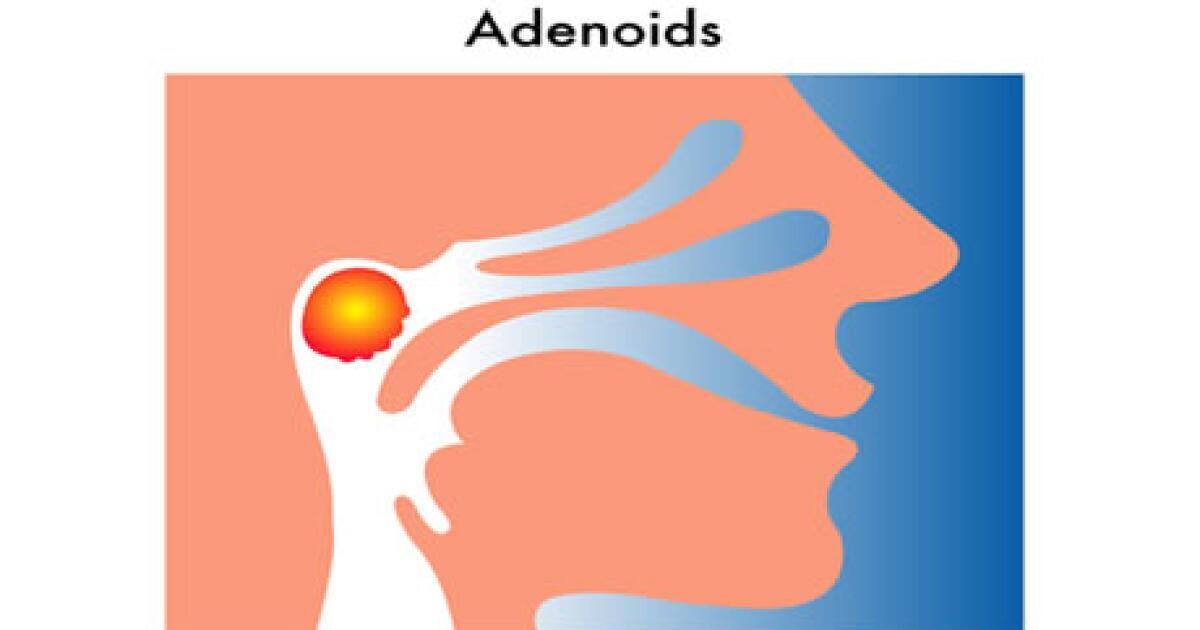 Adenoidectomy Risks Adenoidectomy (Adenoid Removal): Why It's Done, Risks, What to Expect