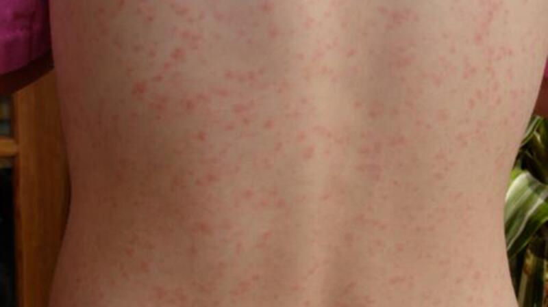 Red Spots Skin - Causes and