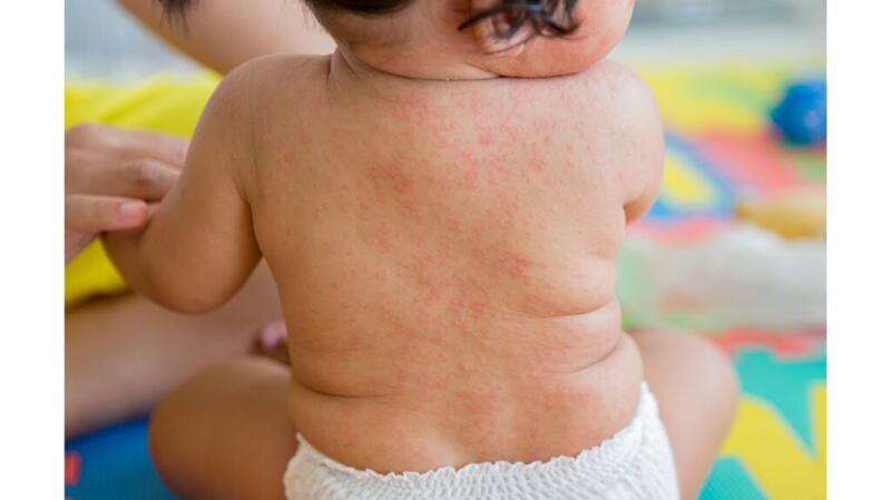 baby with rash over entire back due to roseola, a viral infection