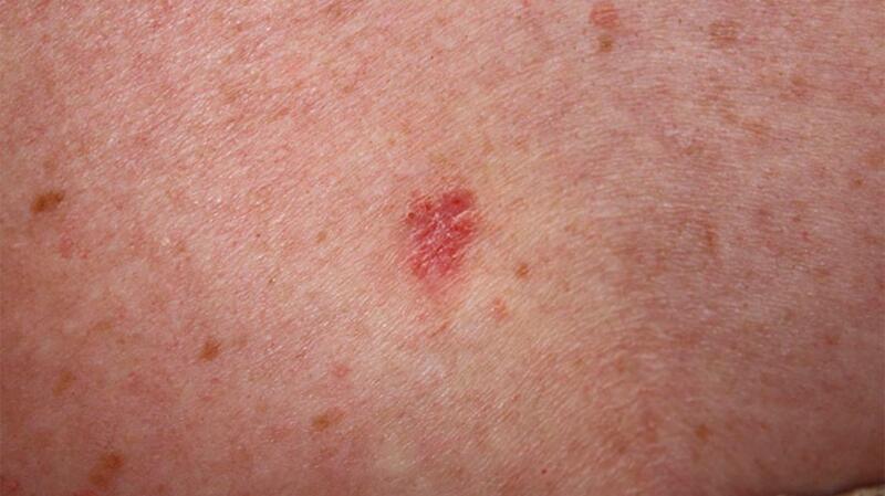 Ulcerative Colitis Rashes: Skin Conditions, Symptoms, Treatment