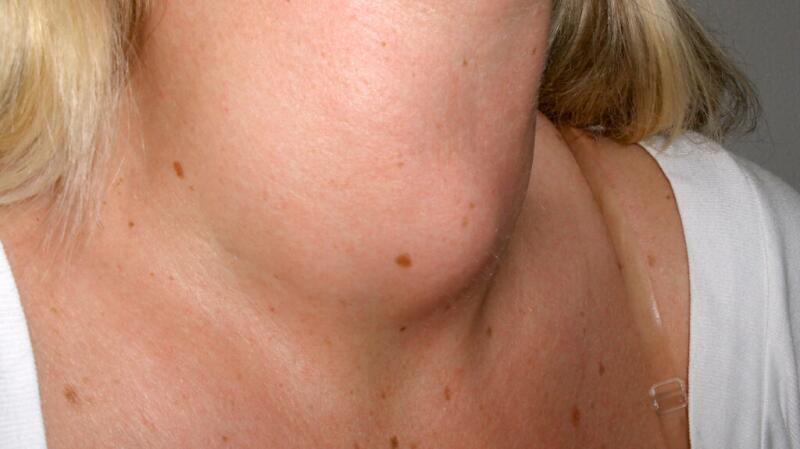 goiter-body2-1024x575.jpg