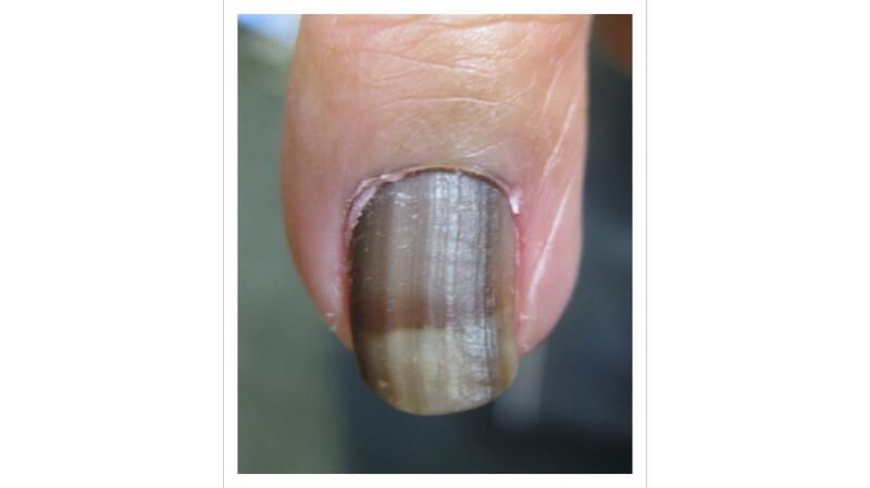 melanotic macule nail Melanonychia: Clues for Diagnosis and the Importance of Histology Melanonychia: when should we worry?