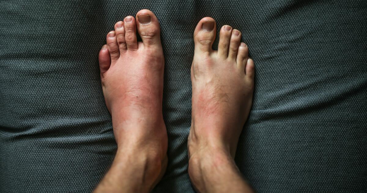 Psoriatic Arthritis Toes Psoriatic Arthritis Hands