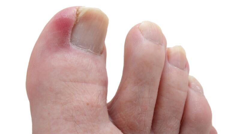 Say Goodbye to Ingrown Toenails — PodiatryCare, P.C. and the Heel Pain  Center