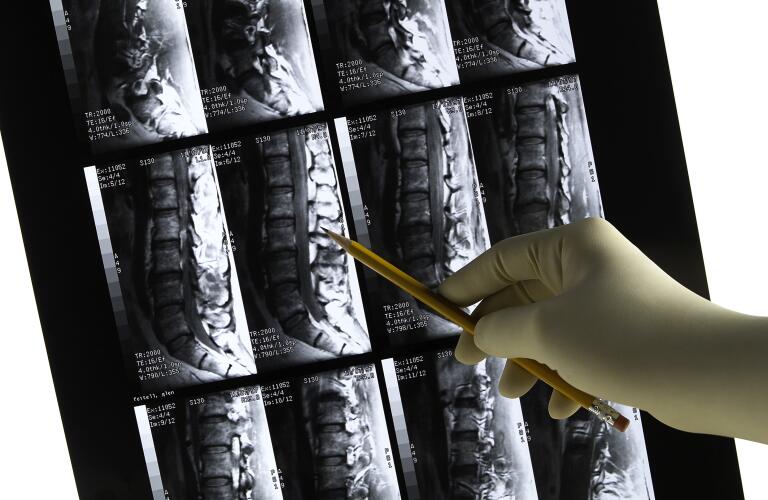 Lower back MRI scan with gloved physician's hand & pencil