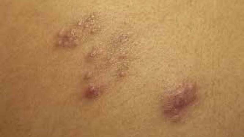 A medical image of metastatic Crohn's disease.