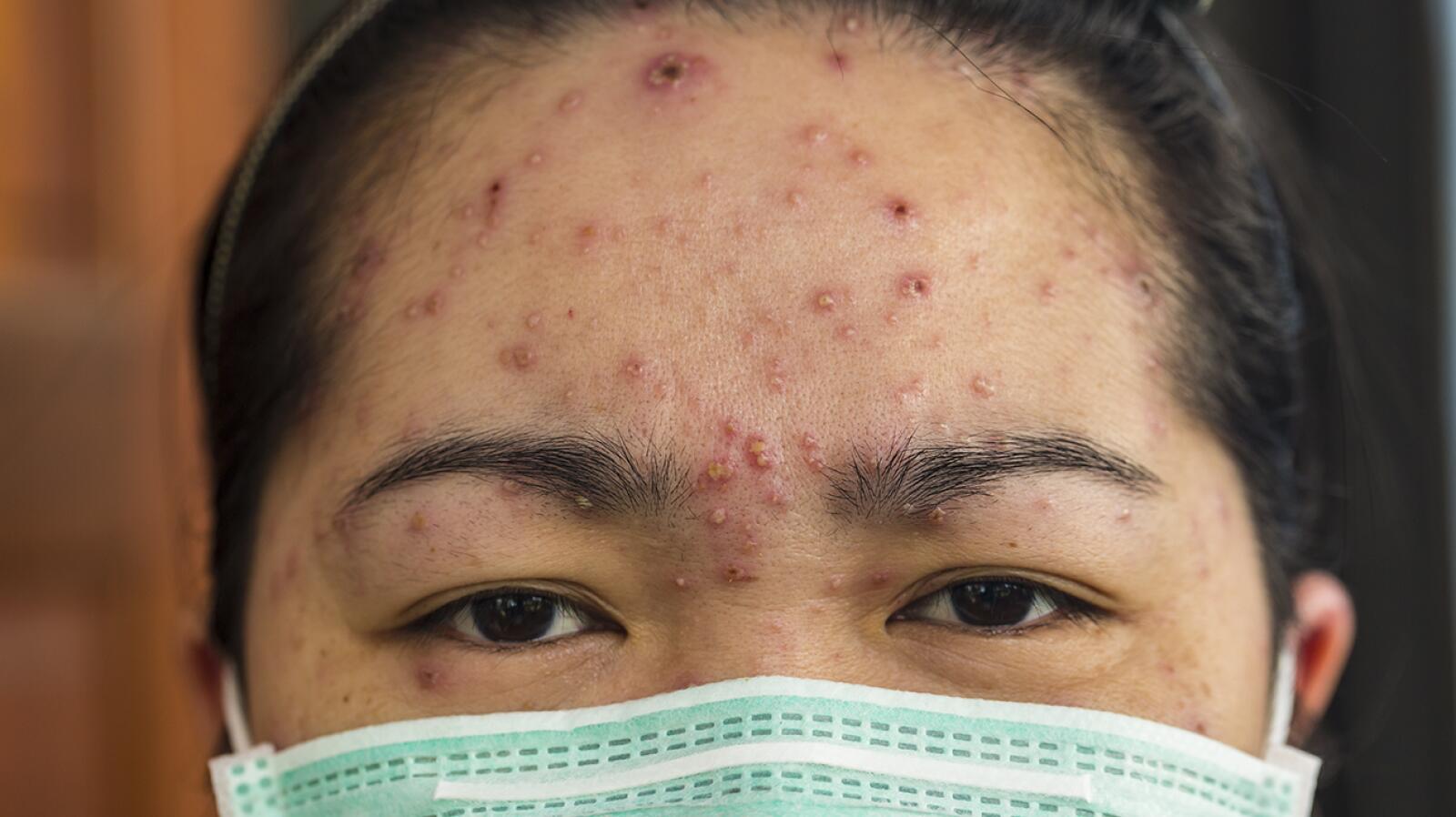 Chickenpox: A Complete Guide to Symptoms, Spread, and More