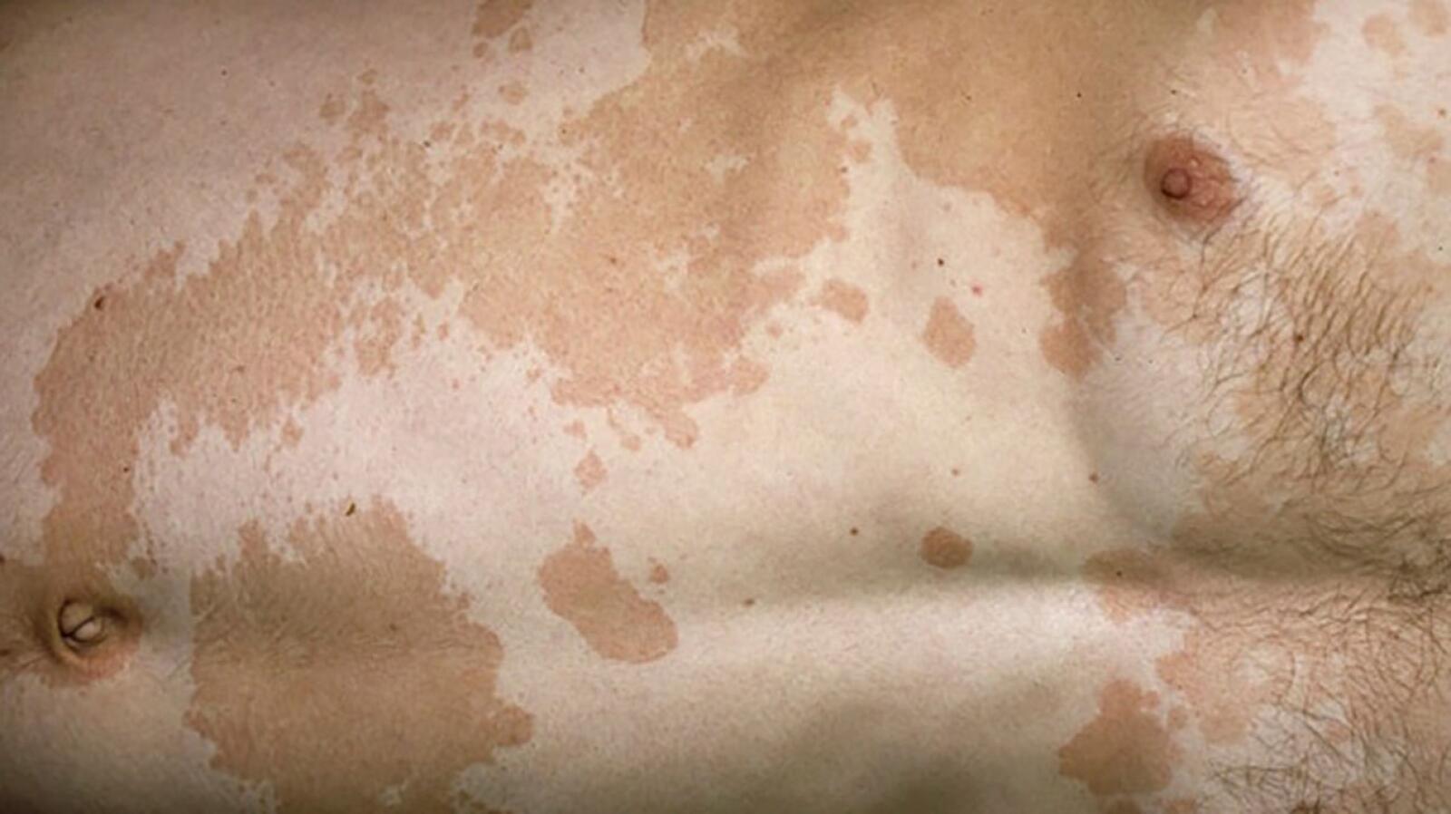 Treating Hypopigmentation Causes, Remedies, and More