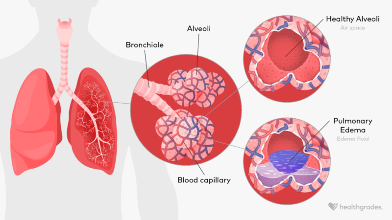 pulmonary edema diagram