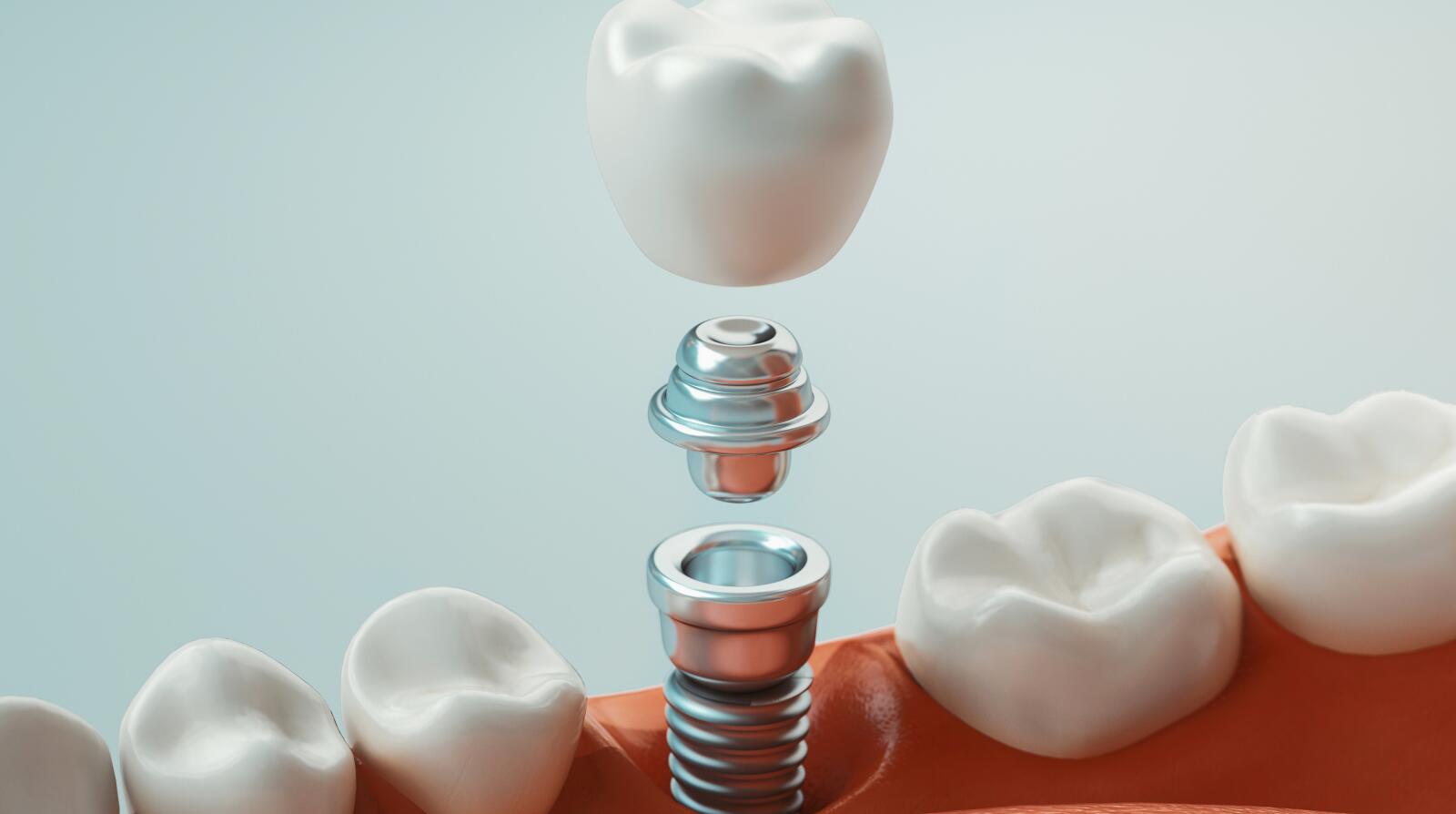 Artificial Teeth 6 Things to Know Artificial Teeth Options