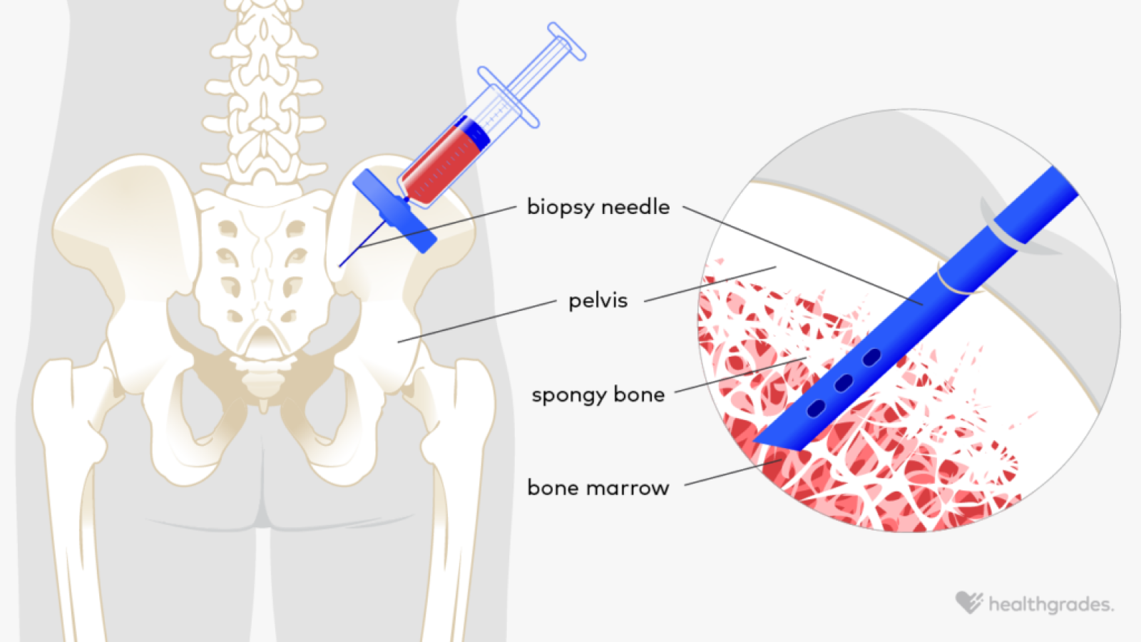 Bone Marrow Aspiration Purpose Procedure And More bone-marrow-aspiration-purpose-procedure-and-more