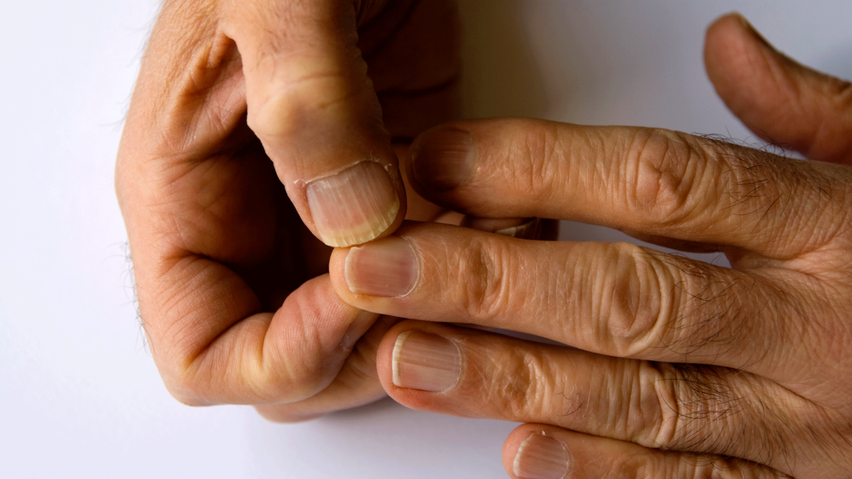 Nail Ridges - Symptoms, Causes, Treatments