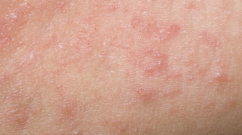 12 Things to Know About Shingles