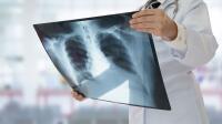 Decoding the Stages of Lung Cancer