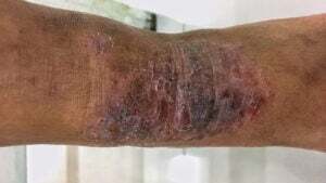 1-flexural-eczema-skin-slide3-hg-300x169.jpg