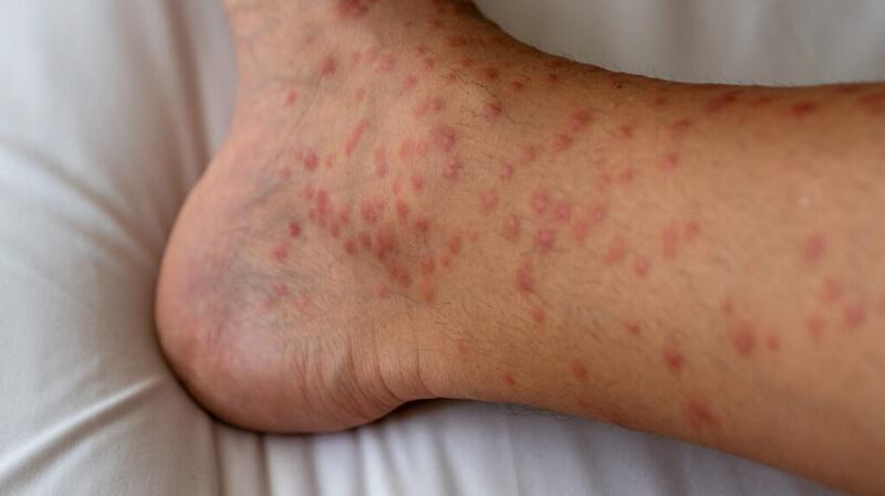 Samler blade greb maler Red Spots on Skin - Causes and Treatment