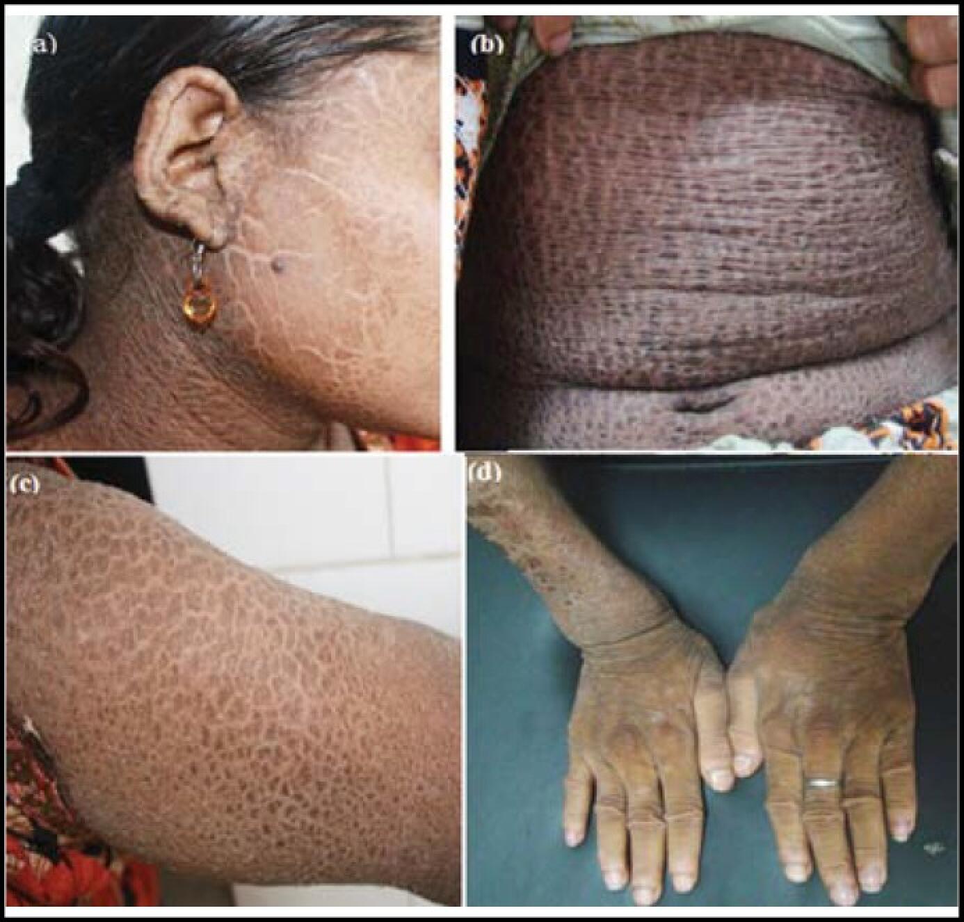 Ichthyosis Types, Symptoms, Causes, and More