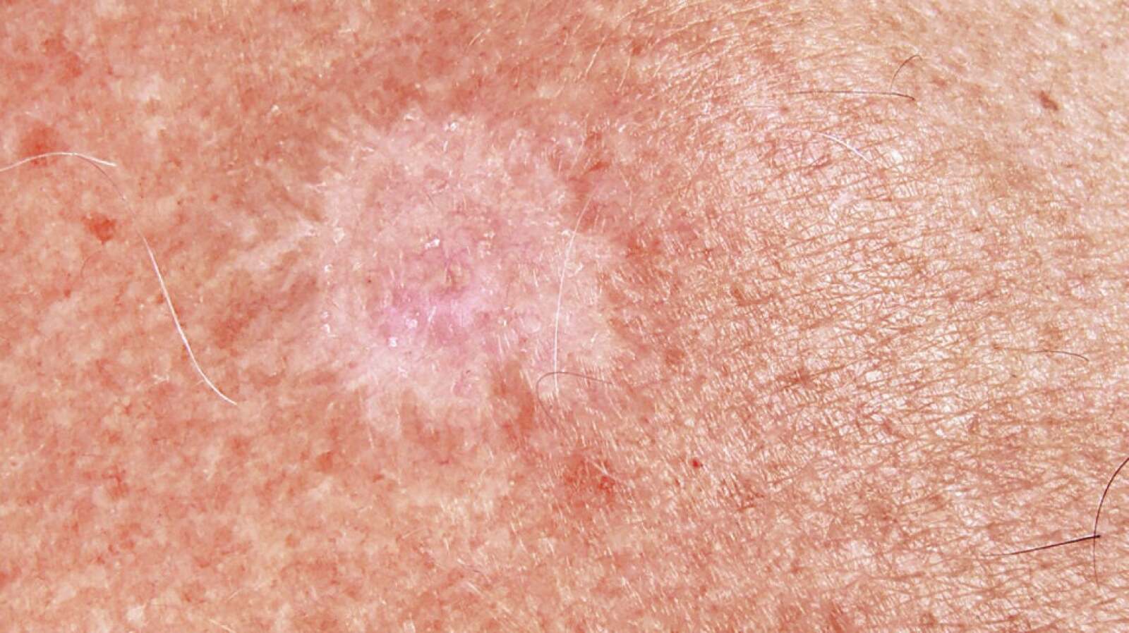 Images of Basal Cell Carcinoma: Pictures, Diagnosis, and More
