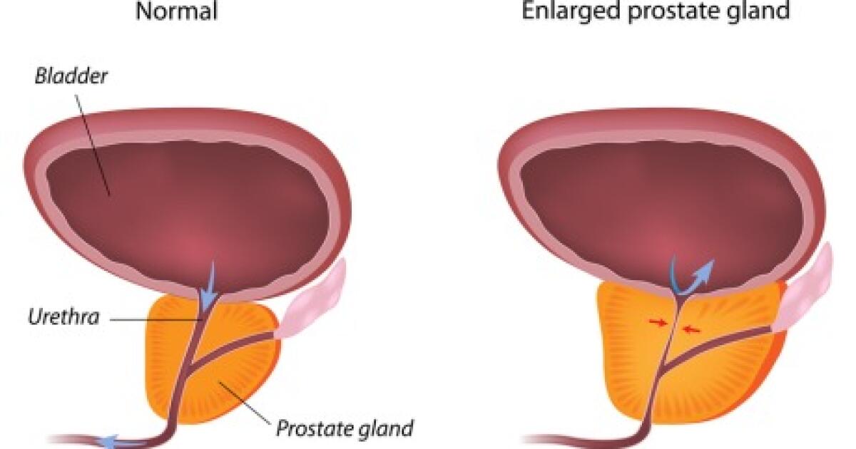 adenom de prostată și prostatita