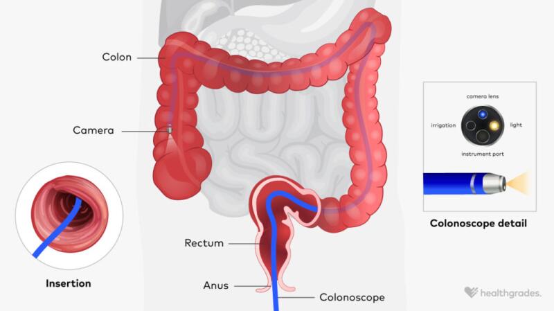 Medical illustration of how a colonoscopy is performed in the lower intestine
