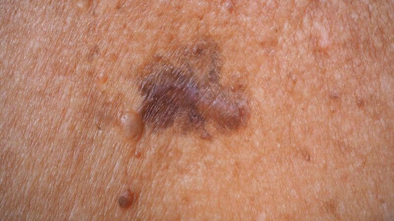 Ulcerative Colitis Rashes: Skin Conditions, Symptoms, Treatment