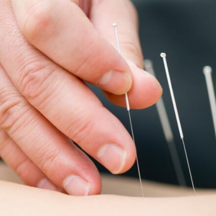 Acupuncturists identify and treat acupoints on your skin that correspond to your signs and symptoms.
