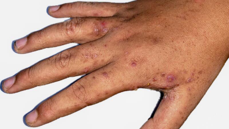 Rash on Hands: Symptoms, Treatments, Causes, More