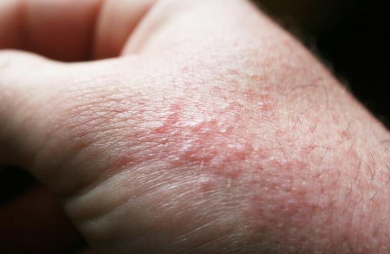 Poison Oak Rash On Skin Close Up