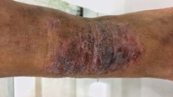 Extensor Rash Flexural Eczema: Causes, Symptoms, and Treatments