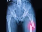 fractured femur, thigh bone on x-ray image