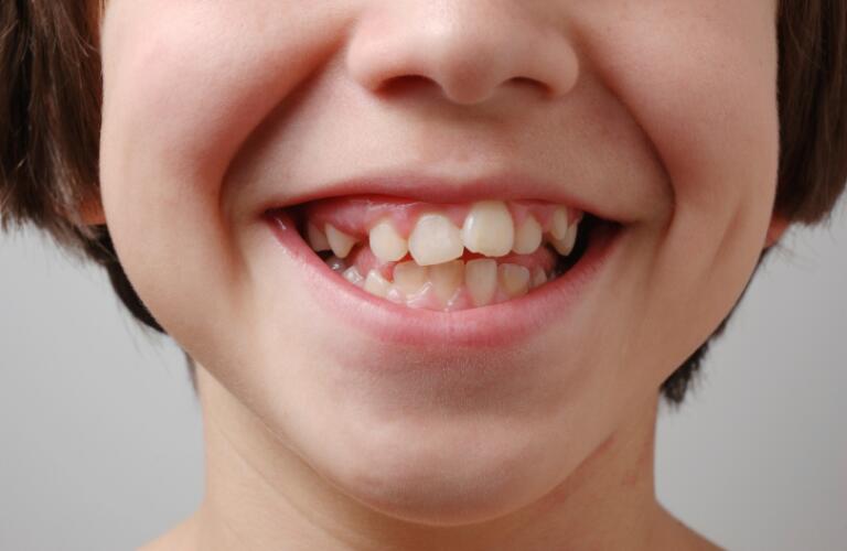 Crooked Teeth Before Braces