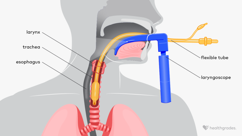 An illustration of intubation