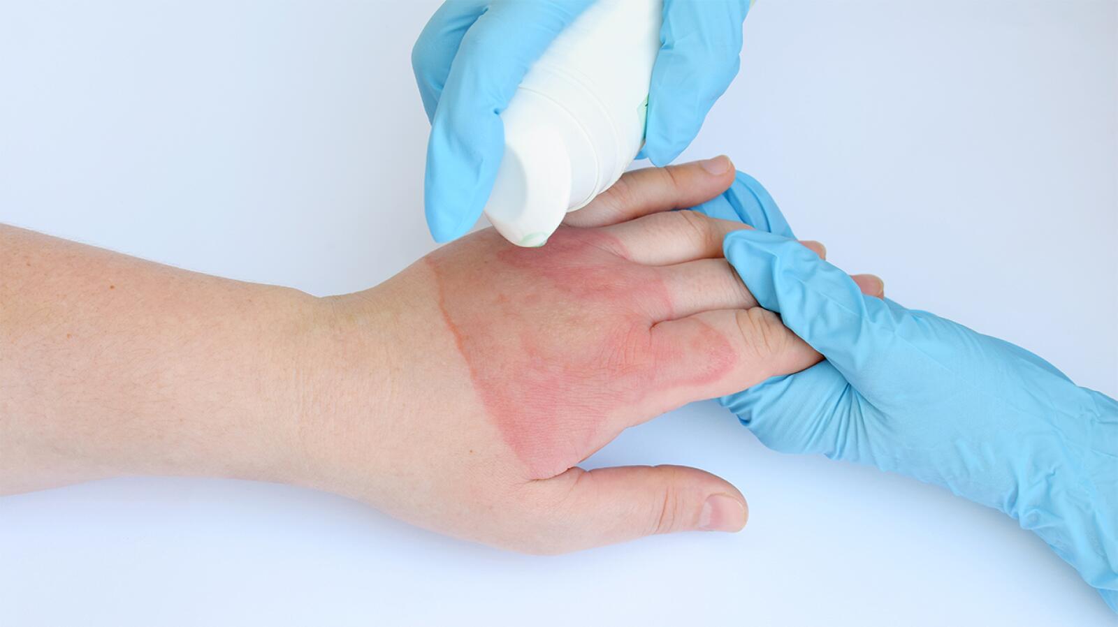 SecondDegree Burn Causes, Symptoms, and Treatment