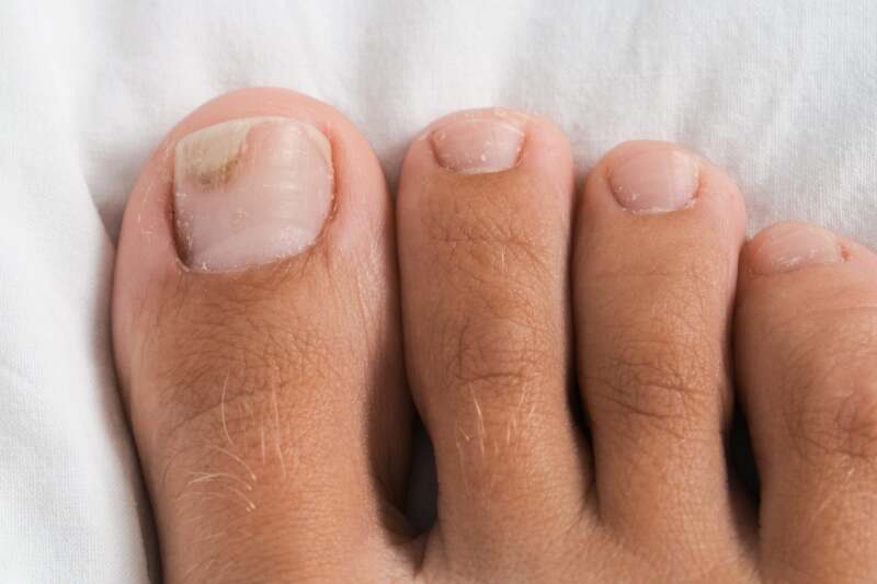 Psoriatic Arthritis Nails Symptoms Treatment And More psoriatic-arthritis-nails-symptoms-treatment-and-more