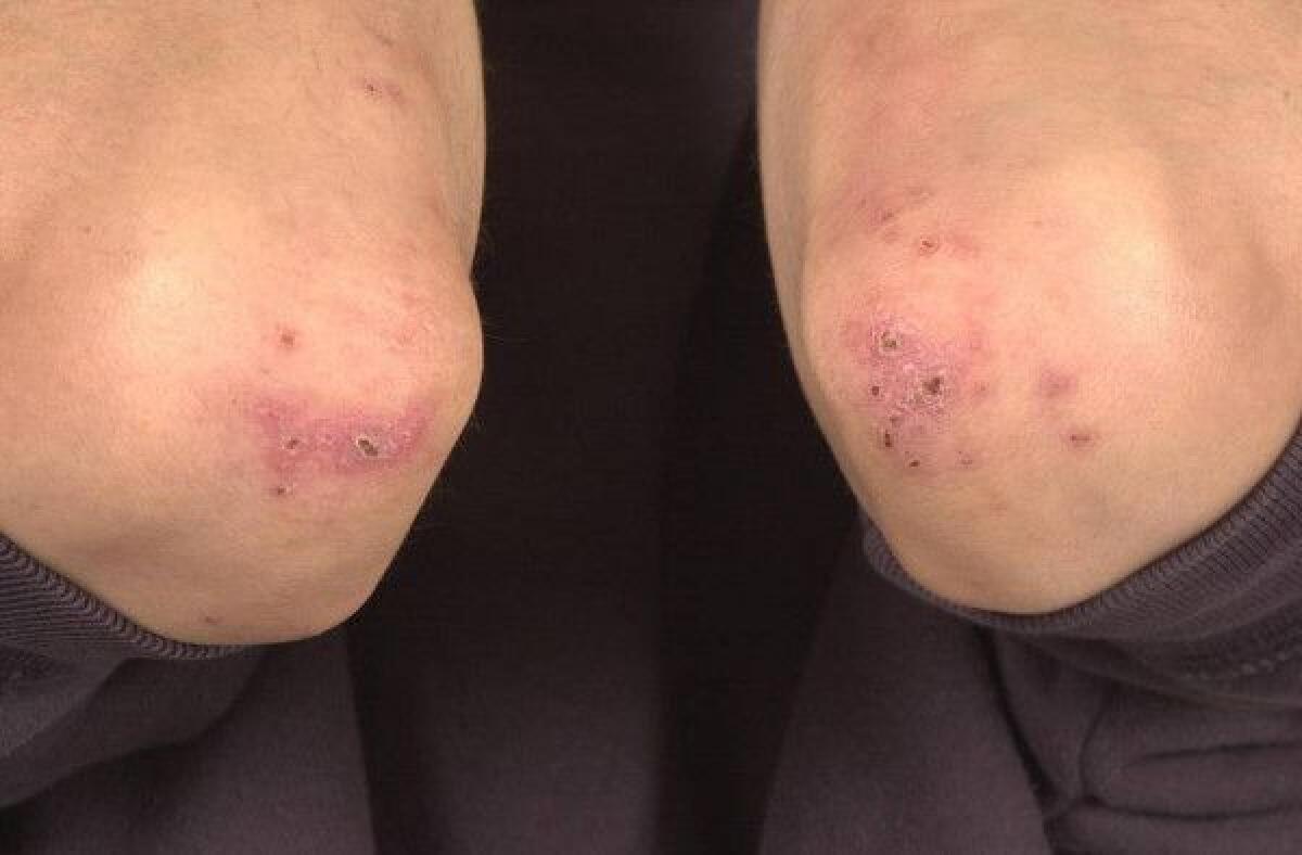 Ulcerative Colitis Rashes: Skin Conditions, Symptoms, Treatment