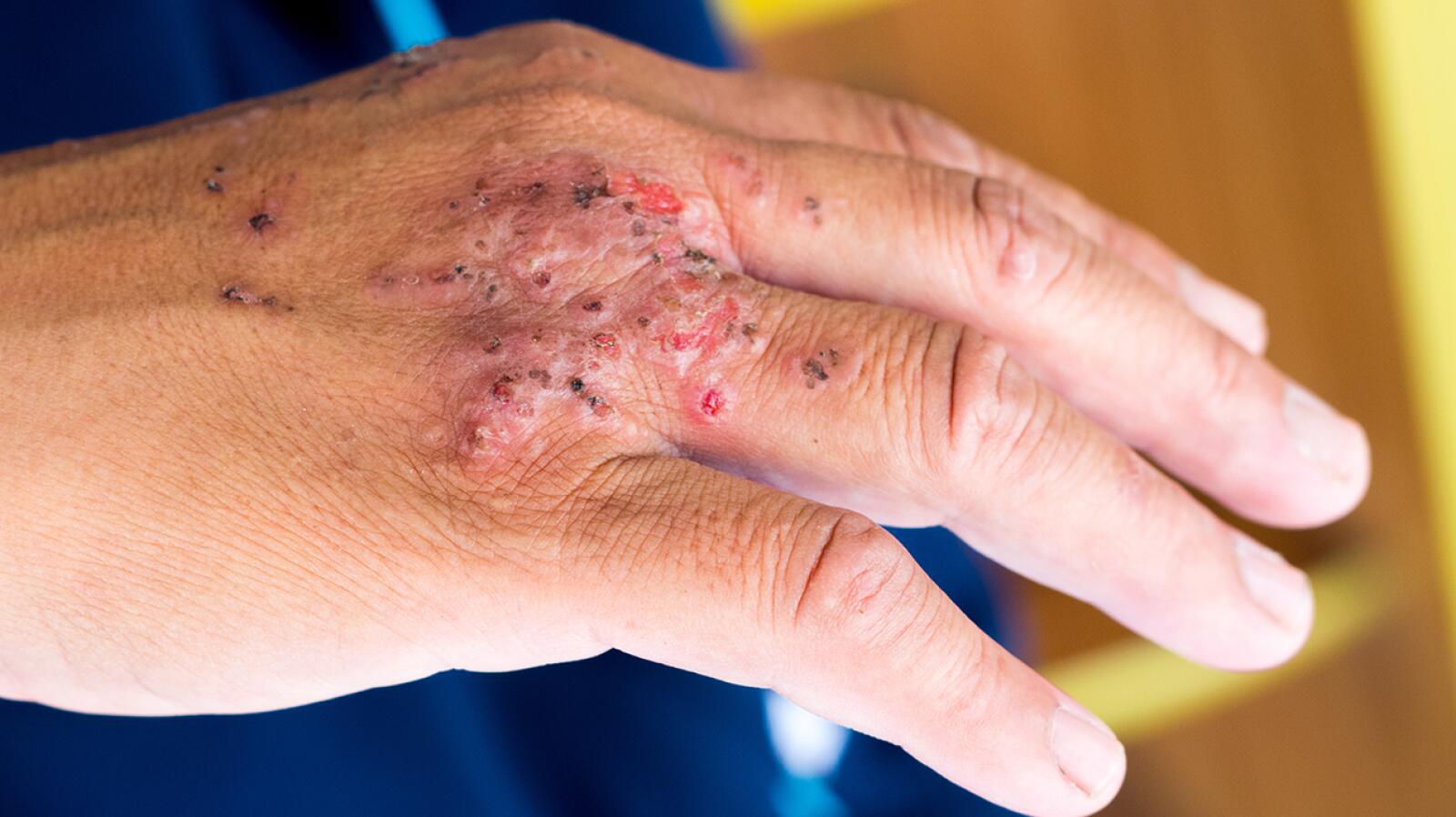 Ant Bites Symptoms, Treatments, Prevention, and More
