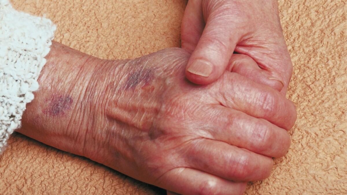 Bulging Veins Symptoms Causes Treatments