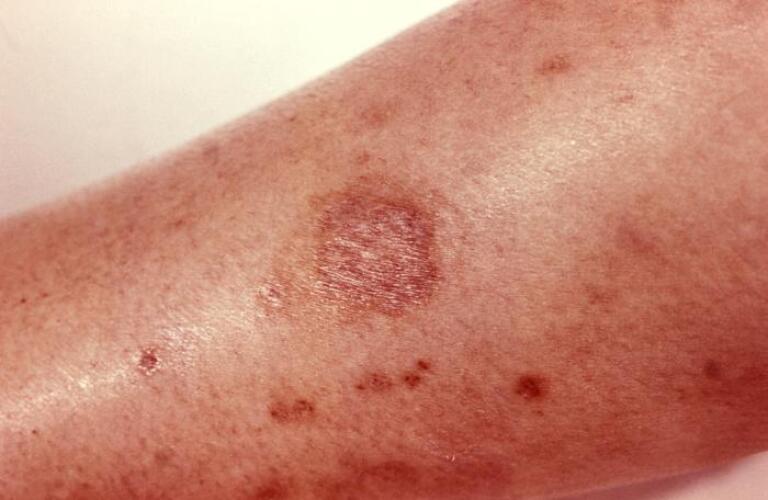 Close-up of scarred wound from brown recluse spider bite